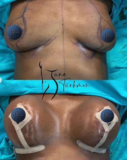 breast uplift-before-after-istanbul-turkey